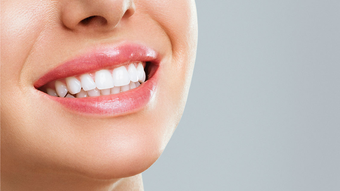 Zubne ljuskice (Veneers)